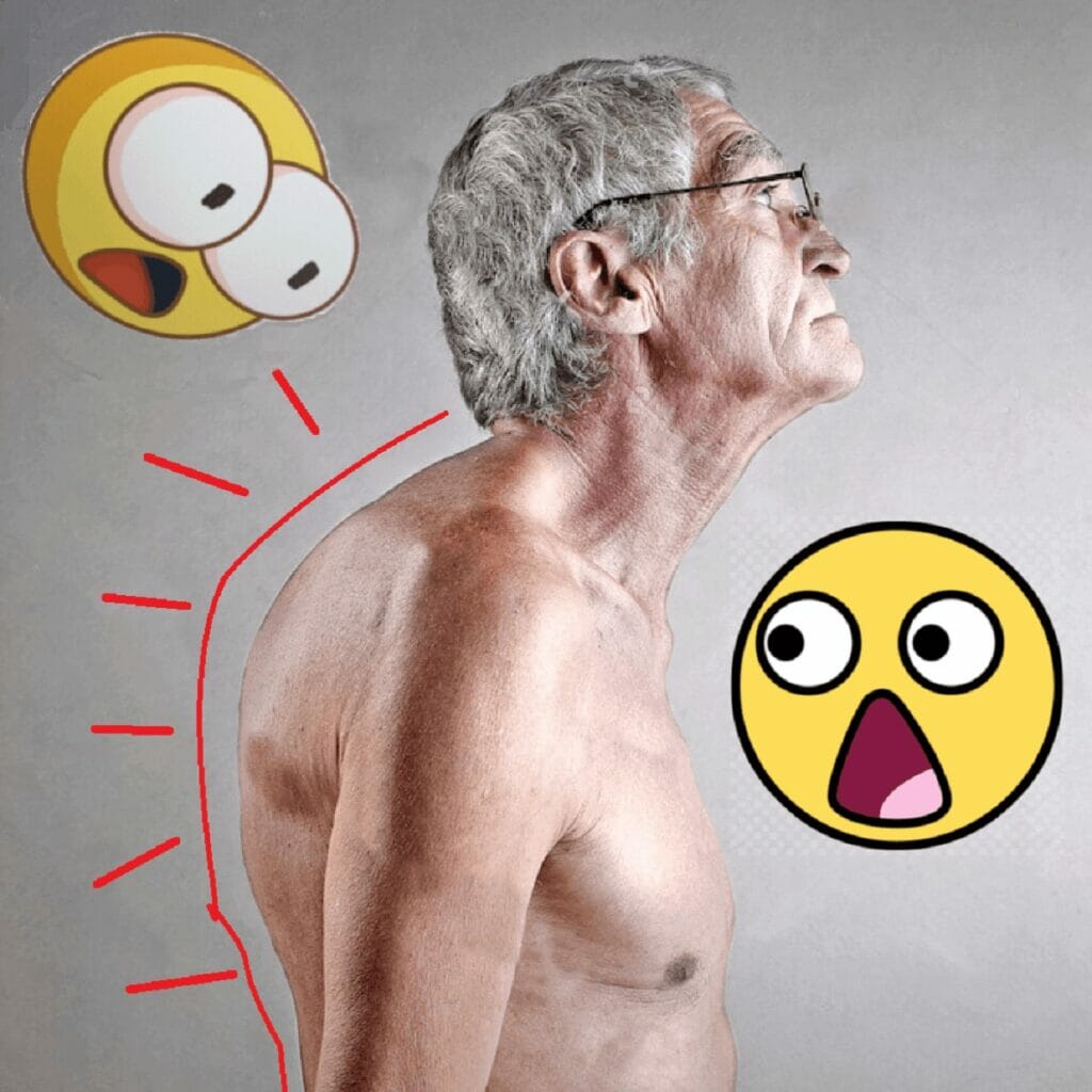 A man with a hunchback that needs a smart posture corrector to improve it